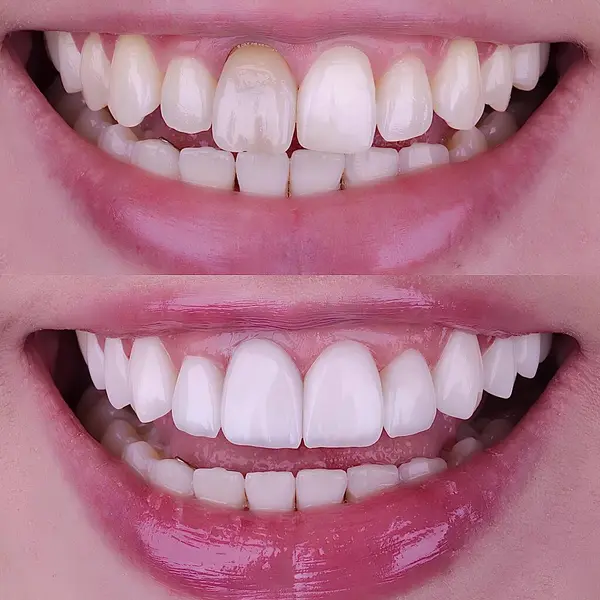 Diş hekimliğinde estetik gülümseme tasarımı tedavisi. Kaplamalı diş tedavisi, diş implantları ve porselen kaplamalar. Gülümse makyaj ve diş bakımı öncesi ve sonrası. 