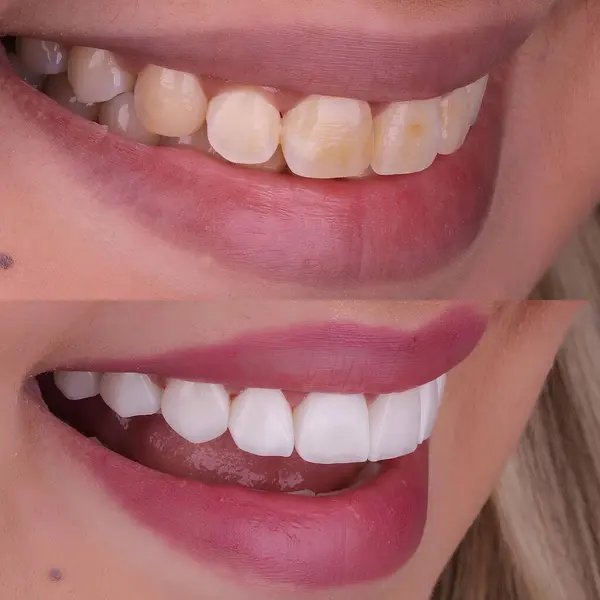 Diş hekimliğinde estetik gülümseme tasarımı tedavisi. Kaplamalı diş tedavisi, diş implantları ve porselen kaplamalar. Gülümse makyaj ve diş bakımı öncesi ve sonrası. 