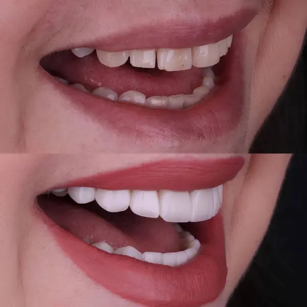 Diş hekimliğinde estetik gülümseme tasarımı tedavisi. Kaplamalı diş tedavisi, diş implantları ve porselen kaplamalar. Gülümse makyaj ve diş bakımı öncesi ve sonrası. 