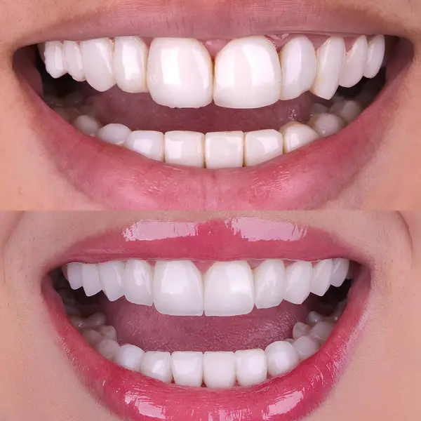 Diş hekimliğinde estetik gülümseme tasarımı tedavisi. Kaplamalı diş tedavisi, diş implantları ve porselen kaplamalar. Gülümse makyaj ve diş bakımı öncesi ve sonrası. 