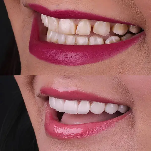 Diş hekimliğinde estetik gülümseme tasarımı tedavisi. Kaplamalı diş tedavisi, diş implantları ve porselen kaplamalar. Gülümse makyaj ve diş bakımı öncesi ve sonrası. 