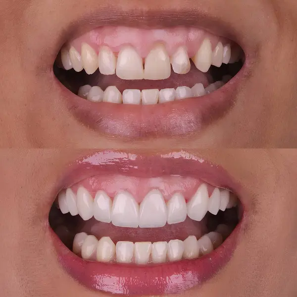 Diş hekimliğinde estetik gülümseme tasarımı tedavisi. Kaplamalı diş tedavisi, diş implantları ve porselen kaplamalar. Gülümse makyaj ve diş bakımı öncesi ve sonrası. 