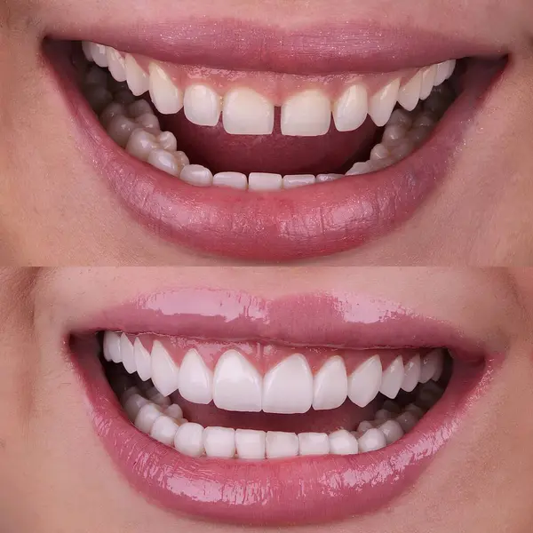 Diş hekimliğinde estetik gülümseme tasarımı tedavisi. Kaplamalı diş tedavisi, diş implantları ve porselen kaplamalar. Gülümse makyaj ve diş bakımı öncesi ve sonrası. 