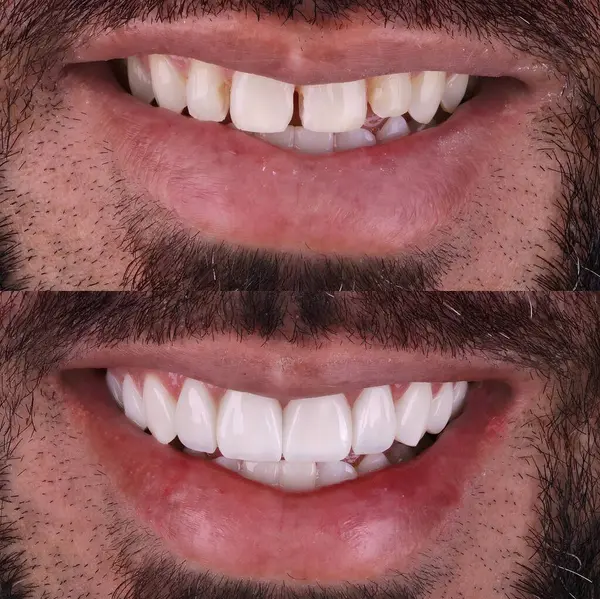 Diş hekimliğinde estetik gülümseme tasarımı tedavisi. Kaplamalı diş tedavisi, diş implantları ve porselen kaplamalar. Gülümse makyaj ve diş bakımı öncesi ve sonrası. 