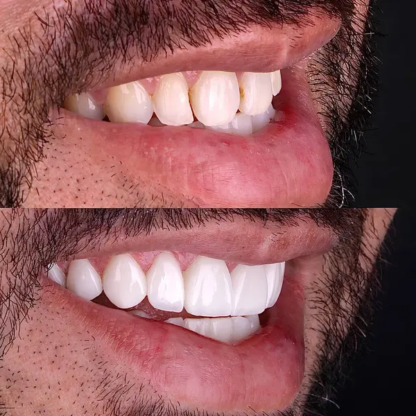 Diş hekimliğinde estetik gülümseme tasarımı tedavisi. Kaplamalı diş tedavisi, diş implantları ve porselen kaplamalar. Gülümse makyaj ve diş bakımı öncesi ve sonrası. 