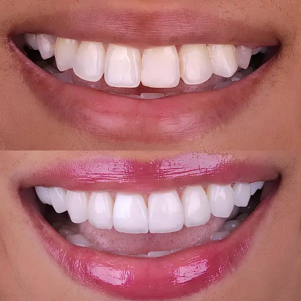 Diş hekimliğinde estetik gülümseme tasarımı tedavisi. Kaplamalı diş tedavisi, diş implantları ve porselen kaplamalar. Gülümse makyaj ve diş bakımı öncesi ve sonrası. 