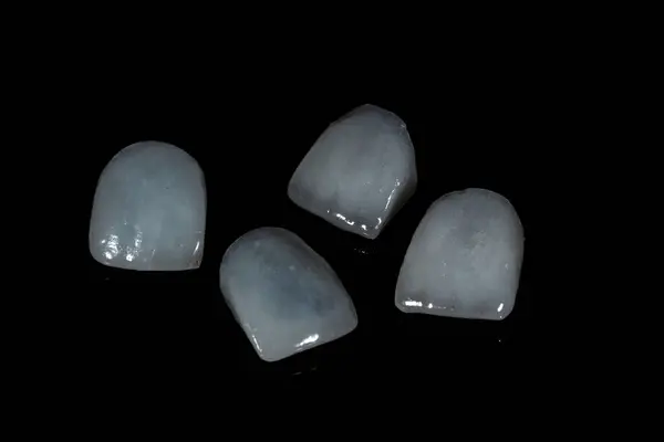 Diş porseleni kaplamalar. Diş hekimliğinde, gülümseme tasarımı tedavisinde diş macunu kaplaması. Gülümse makyaj..