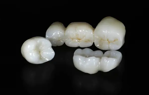 E-max veya zirkon cam seramik porselen kaplama kaplama tedavisi ve diş dökülme vakalarında diş tedavisinde kullanılan implant destekli taç tedavisi. Gülümse tasarımı.