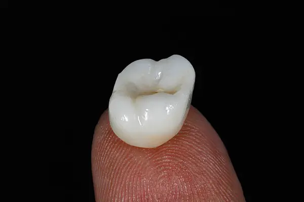 Porselen kaplamalar ve estetik diş hekimliğinde doku restorasyonu için zirkonyum porselen kaplamalar. Diş tasarımı sonrası gülümseme.