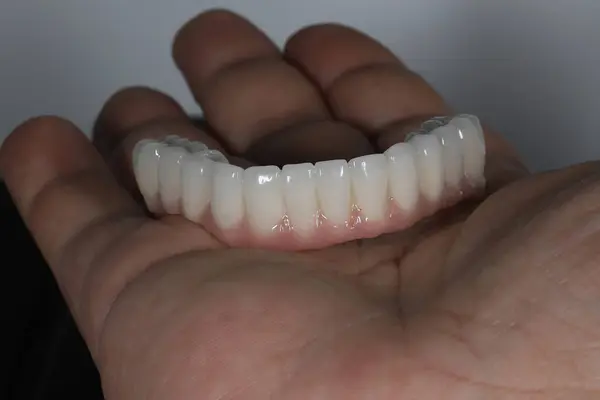 Diş implantı ameliyatı sırasında dört implantla desteklenen tam kemerli diş protezi. 4 'e karşı 4 ve X' e karşı tüm tedaviler. Dişçinin gülümsemesi..