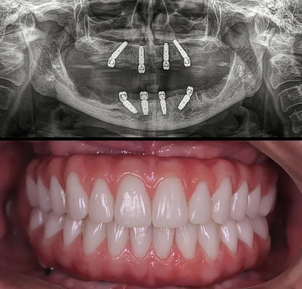 Diş implantı ameliyatında tamamen donanımlı bir erkek hasta için implantlarda üst ve alt diş protezleri. Öncesinde ve sonrasında diş hekimi. Gülümseme makyajı. Diş röntgeni