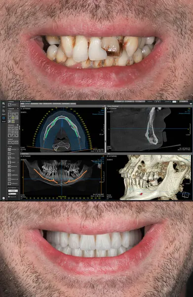 Diş hekimliğinde tüm dişlerini kaybeden hastalar için tam kemer destekli diş protezi tedavisi. Dörde karşı dört, gülümseme makyajı, önce ve sonra diş bakımı..