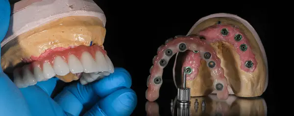 Diş hekimliğinde implant tedavisi ile tam kemerli diş protezi. Nakil destekli hibrit protez olarak bilinen metal çubuklu tam kemerli porselen diş protezi..