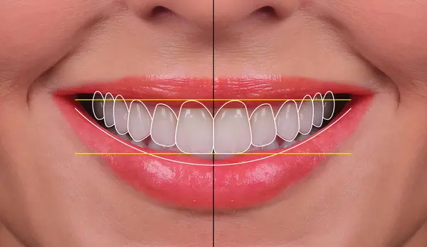 Diş ve çene cerrahisinde elmacık kemiğine implantlar yerleştirilmiş ve hepsinde 4 tekniği kullanılarak tam kemerli diş protezi kullanılmıştır. önce sonra