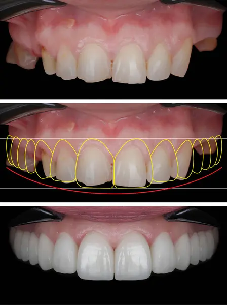 Diş ve çene cerrahisinde elmacık kemiğine implantlar yerleştirilmiş ve hepsinde 4 tekniği kullanılarak tam kemerli diş protezi kullanılmıştır. önce sonra