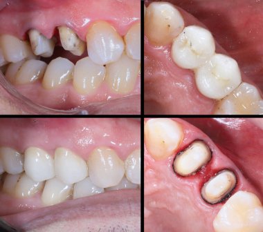 Estetik dişçilikte, E-Max ve zirkon porselen kaplamalar dişleri hizalamak ve soluk dişleri tedavi etmek için kullanılır. Gülümsemeden önce ve sonra diş bakımı. Diş ve diş tedavisi gülümseme tasarımı