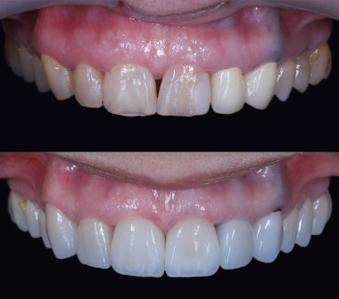 Estetik dişçilikte, E-Max ve zirkon porselen kaplamalar dişleri hizalamak ve soluk dişleri tedavi etmek için kullanılır. Gülümsemeden önce ve sonra diş bakımı. Diş ve diş tedavisi gülümseme tasarımı