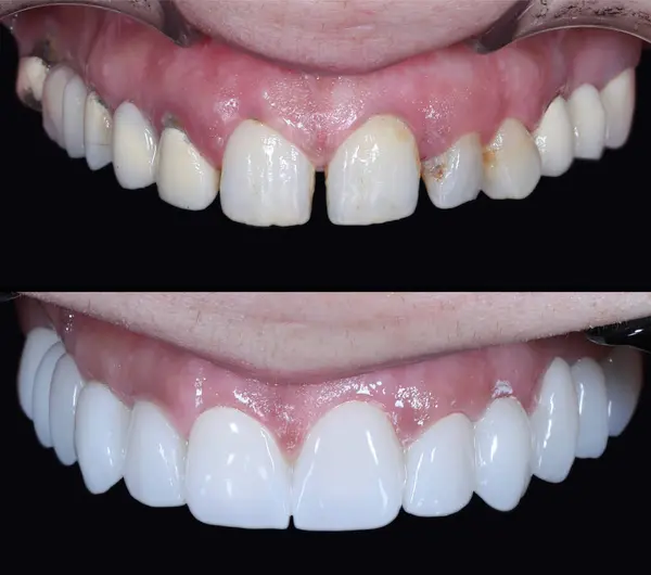 Estetik dişçilikte, E-Max ve zirkon porselen kaplamalar dişleri hizalamak ve soluk dişleri tedavi etmek için kullanılır. Gülümsemeden önce ve sonra diş bakımı. Diş ve diş tedavisi gülümseme tasarımı