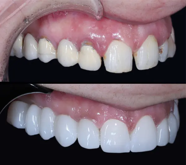 Estetik dişçilikte, E-Max ve zirkon porselen kaplamalar dişleri hizalamak ve soluk dişleri tedavi etmek için kullanılır. Gülümsemeden önce ve sonra diş bakımı. Diş ve diş tedavisi gülümseme tasarımı