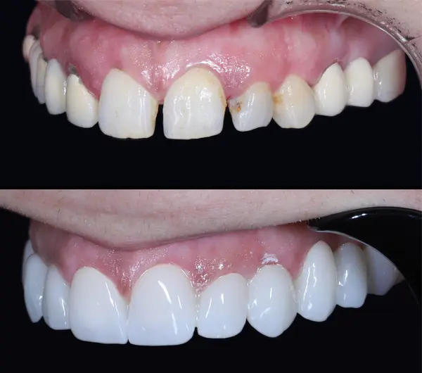 Estetik dişçilikte, E-Max ve zirkon porselen kaplamalar dişleri hizalamak ve soluk dişleri tedavi etmek için kullanılır. Gülümsemeden önce ve sonra diş bakımı. Diş ve diş tedavisi gülümseme tasarımı