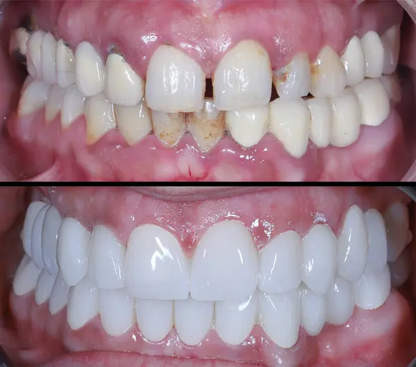 Estetik dişçilikte, E-Max ve zirkon porselen kaplamalar dişleri hizalamak ve soluk dişleri tedavi etmek için kullanılır. Gülümsemeden önce ve sonra diş bakımı. Diş ve diş tedavisi gülümseme tasarımı