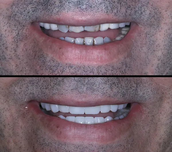 Estetik dişçilikte, E-Max ve zirkon porselen kaplamalar dişleri hizalamak ve soluk dişleri tedavi etmek için kullanılır. Gülümsemeden önce ve sonra diş bakımı. Diş ve diş tedavisi gülümseme tasarımı