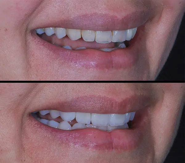 Estetik dişçilikte, E-Max ve zirkon porselen kaplamalar dişleri hizalamak ve soluk dişleri tedavi etmek için kullanılır. Gülümsemeden önce ve sonra diş bakımı. Diş ve diş tedavisi gülümseme tasarımı