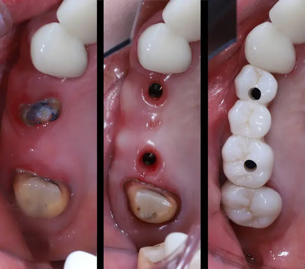 Köprü protez tedavisi ve diş implantı cerrahi terapisi. Diş implantı destekli porselen köprü kaplaması tedavisinden önce ve sonra. Öncesinde dişçi.