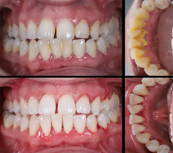 Diş hekimliğinde, tartar temizliği denilen ölçeklendirme tedavisi diş ve diş etlerinin sağlığı içindir. Tartar temizleme tekniği ve birikmiş yiyecek artıkları, önce ve sonra diş sağlığı..