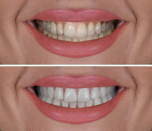Diş hekimliğinde estetik gülümseme tasarımı tedavisi. Kaplamalı diş tedavisi, diş implantları ve porselen kaplamalar. Gülümse makyaj ve diş bakımı öncesi ve sonrası. 