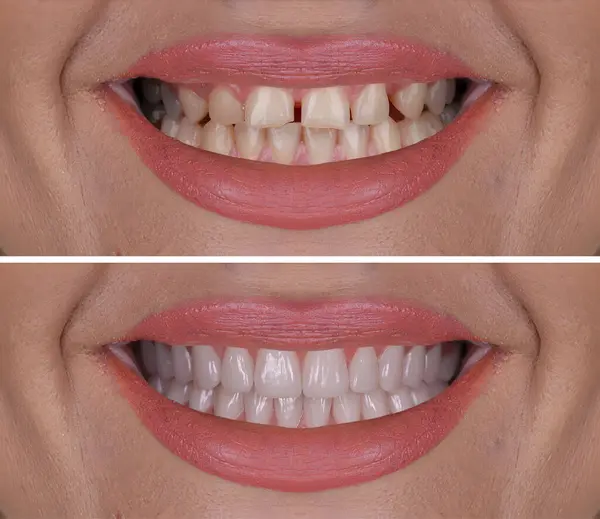 Diş hekimliğinde estetik gülümseme tasarımı tedavisi. Kaplamalı diş tedavisi, diş implantları ve porselen kaplamalar. Gülümse makyaj ve diş bakımı öncesi ve sonrası. 