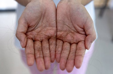 Saçlar eline dökülüyor. Saçlar dökülüyor..