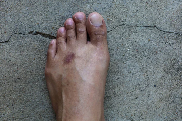 left foot of man is pain condition , dry foot