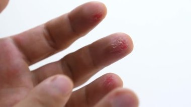 Close-up of man palm hand with injured fingers. Scratched skin bloody wound on male fingers with inflammation. Fresh red cuts on fingers on white background. Concept of hard manual work. Damaged arm.
