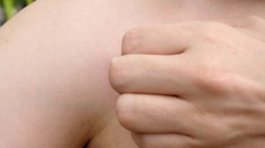 Man scratching a swollen, red insect bite on chest. Close-up shot shows discomfort and itchiness, allergic reaction to the bite on the persons breast. Perfect for medical or health-related projects