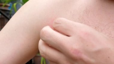 Man chest is bitten by mosquitoes and develops bumps on skin during summer. He suffers from itchy skin and scratches irritated areas. Allergic reaction to insect bites, food, and medicine allergies.