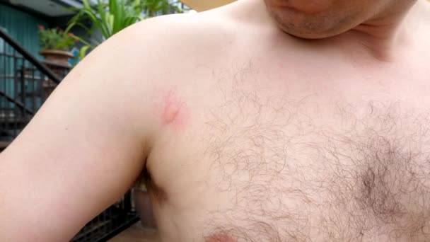 Mosquitoes Leave Mark Man Chest Form Itchy Bites Touches One — Vídeos de Stock