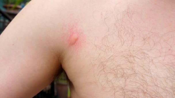 目に見える虫刺され いらいらする皮膚を示す男性の胸のクローズアップ 蚊の刺されによるアレルギーの概念 蚊が媒介するウイルス デングウイルス 黄熱病 西ナイル マラリア — ストック動画