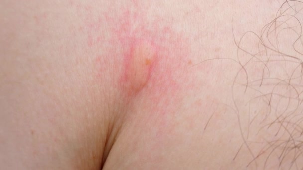 Szúnyogcsípés Férfi Mellkason Irritált Bőr Látható Rovarcsípés Dengue Vírus Sárgaláz — Stock videók
