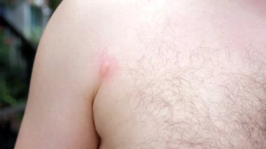 Böceklere alerjisi olan bir adam kırmızı yaralar, kaşıntı ve göğüs derisi tahrişi yaşar. Isırığa, yiyeceğe ve ilaca alerjik reaksiyon deri iltihabına ve kızarıklığa yol açar.