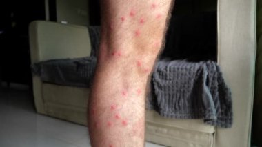 Cilt alerjisi, alerji isiliği ya da böcek ısırığı semptomları olan erkek bacağına yakın çekim. Dermatolojik durumları vurguluyor. Sağlık ve dermatoloji.