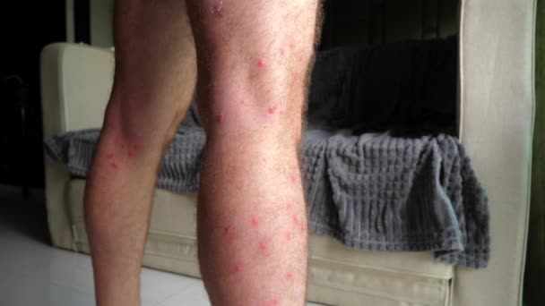 Mann Mit Hautreizungen Mit Sichtbaren Roten Flecken Bein Symptomatisch Für — Stockvideo