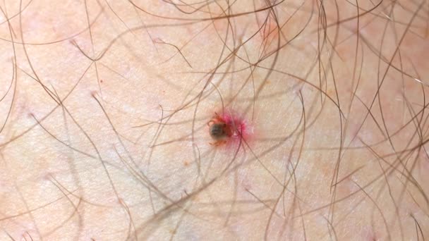 진드기 물리는 인간의 피부의 클로즈업 잠재적으로 Lyme 진드기 질환을 일으키는 — 비디오
