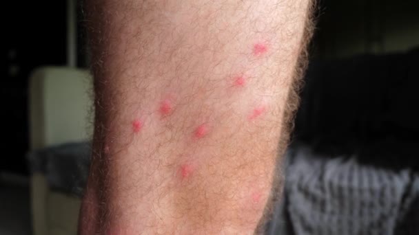 Close Dari Kaki Manusia Dengan Gigitan Nyamuk Terlihat Penggunaan Perawatan — Stok Video