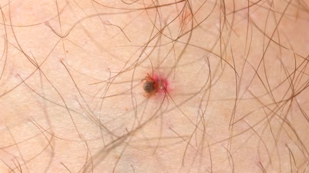 近视蜜蜂在人类皮肤上的叮咬会引起过敏反应 有明显的红肿 昆虫叮咬过敏及急救治疗的医疗及健康意识 — 图库视频影像