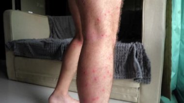 Cilt alerjisi olan biri, ev ortamında bacağında kırmızı lekeler olduğunu gösteriyor. Muhtemel cilt bakımı gerektiren dermatolojik bir durum. Sağlık bilinci ve cilt bakımı.