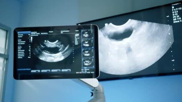 Камера Показує Монітор Ультразвукової Машини Рух Екрані Вона Показує Лікарям — стокове відео