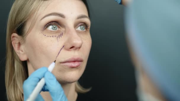 肩部上方是女性面部手术痕迹的照片 近距离观察远处的病人 医生在鼻唇褶皱上画了一条线 高质量的4K镜头 — 图库视频影像