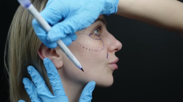 Procesul Marcare Chirurgicală Pomeților Zonei Din Jurul Ochilor Feței Feminine — Videoclip de stoc