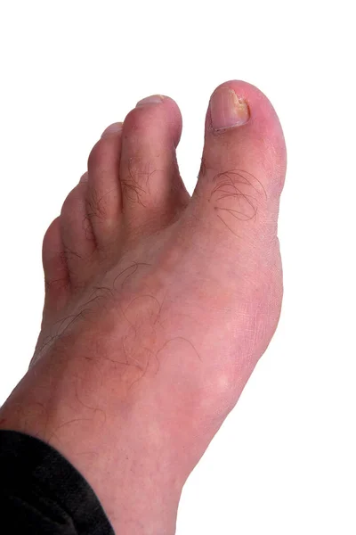 Nail Fungus Infection Big Toe Fungal Infection Fingernails Toe Ringworm — Stock Photo, Image
